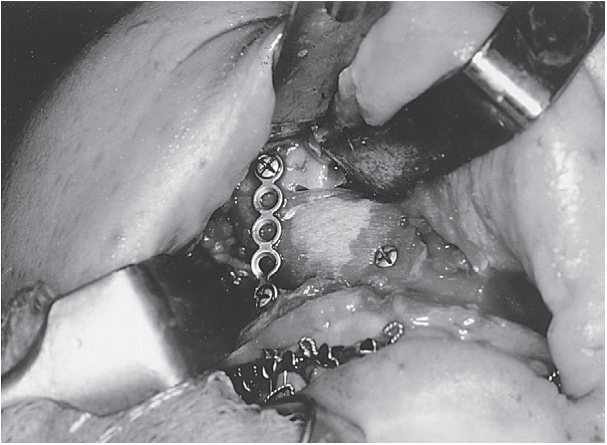 FIGURE 16-34, cont’d G, Orbital floor reconstruction bone plate used to span the defect. Autologous bone was placed on top of the plate. H, After repositioning the ZMC, a large defect of the lateral maxillary wall is present. Bone plates were used to span the defect. I, Bone grafts used to reconstruct the lateral maxillary wall. J, Resuspension of facial soft tissue performed before closure. This photograph shows resuspension of the outer layer of the temporalis fascia. K, Postoperative axial CT scans showing repositioning of the ZMC and reconstruction of the zygomatic arch (L).