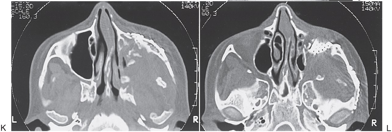 FIGURE 16-34, cont’d G, Orbital floor reconstruction bone plate used to span the defect. Autologous bone was placed on top of the plate. H, After repositioning the ZMC, a large defect of the lateral maxillary wall is present. Bone plates were used to span the defect. I, Bone grafts used to reconstruct the lateral maxillary wall. J, Resuspension of facial soft tissue performed before closure. This photograph shows resuspension of the outer layer of the temporalis fascia. K, Postoperative axial CT scans showing repositioning of the ZMC and reconstruction of the zygomatic arch (L).