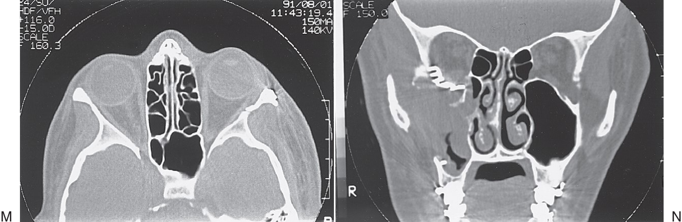 FIGURE 16-34, cont’d M, Alignment of the zygomaticosphenoid suture . N, Postoperative coronal CT scans show reconstruction of the orbital floor with metal plate and bone graft just posterior to the globe and, more posteriorly, in the orbit (O). Frontal (P), right (Q), and left (R) lateral photographs of patient 18 months after surgery.