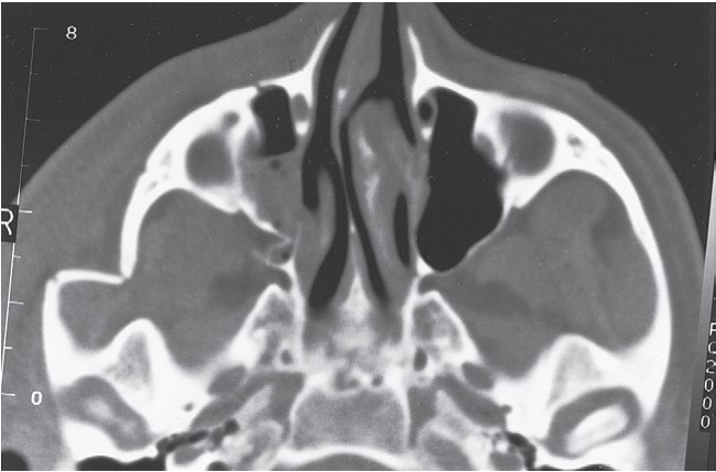 FIGURE 16-36 Patient with low-energy ZMC fracture treated with reduction using a Carroll-Girard screw without fixation. A, Frontal and inferior (B) views of the patient before surgery. Note the significant contour deficit present. C, Axial CT scan at the level of the midglobe shows displacement of the lateral orbital rim and disruption of the lateral orbital wall. D, Axial CT scan at the level of the zygomatic arch shows medial rotation of the posterior (infratemporal) surface of the ZMC into the maxillary sinus. E, Coronal scan posterior to the globe shows notable displacement of the ZMC, but minimal comminution of the orbital floor. After reduction, the position of the ZMC was thought to b