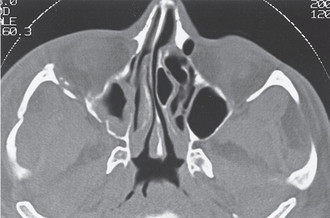 FIGURE 16-36, cont’d G, Postoperative axial CT scan at the level of the zygomatic arch shows satisfactory reduction. H, Postoperative axial CT scan just below the infraorbital rim shows good position of the malar eminence. I, Postoperative coronal CT scan at the posterior surface of the right globe shows satisfactory reduction of the fractures through the lateral orbital wall and floor. J, Coronal CT taken behind the right globe shows a satisfactory contour of the right zygomaticomaxillary buttress and maintenance of the contour of the orbital contents. Frontal (K) and inferior (L) views of patient 5 weeks later showing good symmetry.