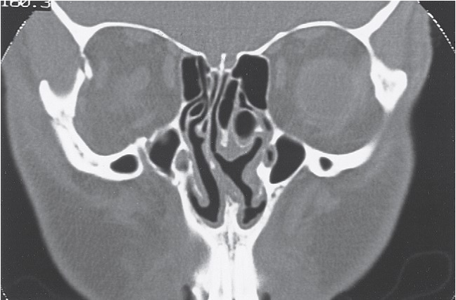 FIGURE 16-36, cont’d G, Postoperative axial CT scan at the level of the zygomatic arch shows satisfactory reduction. H, Postoperative axial CT scan just below the infraorbital rim shows good position of the malar eminence. I, Postoperative coronal CT scan at the posterior surface of the right globe shows satisfactory reduction of the fractures through the lateral orbital wall and floor. J, Coronal CT taken behind the right globe shows a satisfactory contour of the right zygomaticomaxillary buttress and maintenance of the contour of the orbital contents. Frontal (K) and inferior (L) views of patient 5 weeks later showing good symmetry.