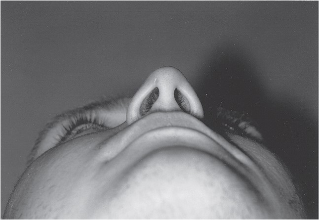 FIGURE 16-36, cont’d G, Postoperative axial CT scan at the level of the zygomatic arch shows satisfactory reduction. H, Postoperative axial CT scan just below the infraorbital rim shows good position of the malar eminence. I, Postoperative coronal CT scan at the posterior surface of the right globe shows satisfactory reduction of the fractures through the lateral orbital wall and floor. J, Coronal CT taken behind the right globe shows a satisfactory contour of the right zygomaticomaxillary buttress and maintenance of the contour of the orbital contents. Frontal (K) and inferior (L) views of patient 5 weeks later showing good symmetry.