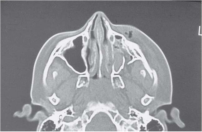 FIGURE 16-37 Patient with low-energy ZMC fracture treated by reduction using Carroll-Girard screw and bone plate fixation along the zygomaticomaxillay buttress. A, Frontal and inferior (B) views of patient with left ZMC fracture. C, Axial CT scan at midglobe level shows minimum displacement of the lateral orbital rim. D, Axial CT scan just below the infraorbital rim shows posteromedial displacement of the malar eminence. Note that the fractures are not comminuted. E, Coronal CT scan showing noncomminuted orbital floor and walls. The patient underwent reduction with a Carroll-Girard screw, but the malar eminence kept rotating inferomedially into the maxillary sinus. Transoral open reduction a