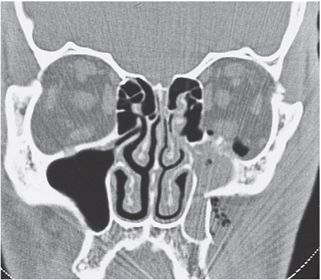 FIGURE 16-37 Patient with low-energy ZMC fracture treated by reduction using Carroll-Girard screw and bone plate fixation along the zygomaticomaxillay buttress. A, Frontal and inferior (B) views of patient with left ZMC fracture. C, Axial CT scan at midglobe level shows minimum displacement of the lateral orbital rim. D, Axial CT scan just below the infraorbital rim shows posteromedial displacement of the malar eminence. Note that the fractures are not comminuted. E, Coronal CT scan showing noncomminuted orbital floor and walls. The patient underwent reduction with a Carroll-Girard screw, but the malar eminence kept rotating inferomedially into the maxillary sinus. Transoral open reduction a