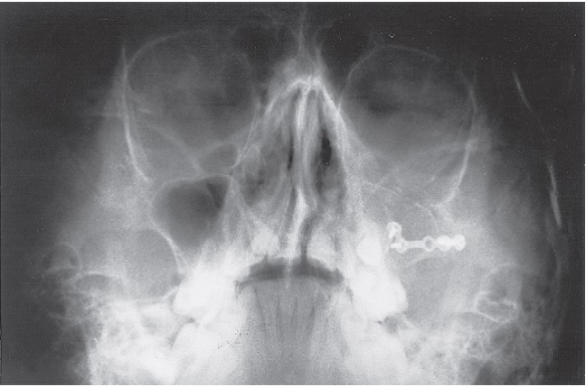 FIGURE 16-37 Patient with low-energy ZMC fracture treated by reduction using Carroll-Girard screw and bone plate fixation along the zygomaticomaxillay buttress. A, Frontal and inferior (B) views of patient with left ZMC fracture. C, Axial CT scan at midglobe level shows minimum displacement of the lateral orbital rim. D, Axial CT scan just below the infraorbital rim shows posteromedial displacement of the malar eminence. Note that the fractures are not comminuted. E, Coronal CT scan showing noncomminuted orbital floor and walls. The patient underwent reduction with a Carroll-Girard screw, but the malar eminence kept rotating inferomedially into the maxillary sinus. Transoral open reduction a