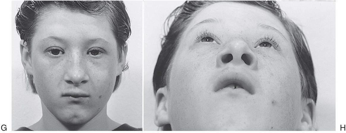 FIGURE 16-37 Patient with low-energy ZMC fracture treated by reduction using Carroll-Girard screw and bone plate fixation along the zygomaticomaxillay buttress. A, Frontal and inferior (B) views of patient with left ZMC fracture. C, Axial CT scan at midglobe level shows minimum displacement of the lateral orbital rim. D, Axial CT scan just below the infraorbital rim shows posteromedial displacement of the malar eminence. Note that the fractures are not comminuted. E, Coronal CT scan showing noncomminuted orbital floor and walls. The patient underwent reduction with a Carroll-Girard screw, but the malar eminence kept rotating inferomedially into the maxillary sinus. Transoral open reduction a