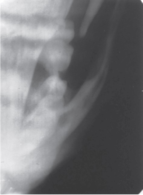 FIGURE 16-38, cont’d F, Postoperative radiograph showing reduction. G, Immediately postoperatively, patient has regained mobility of the mandible. H, Metal and gauze eye patches can be used to protect the reduced arch for several days (I).