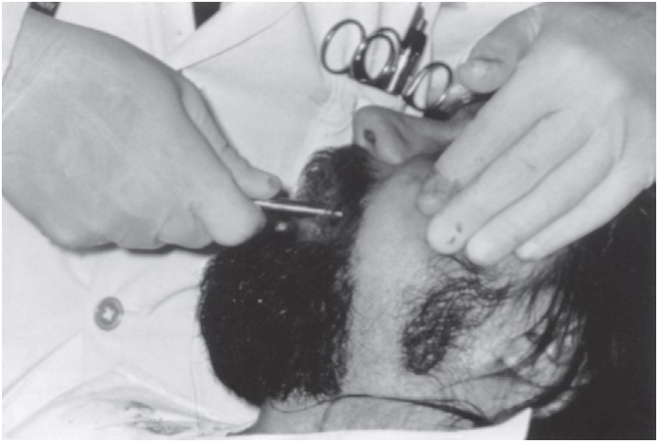FIGURE 16-38, cont’d F, Postoperative radiograph showing reduction. G, Immediately postoperatively, patient has regained mobility of the mandible. H, Metal and gauze eye patches can be used to protect the reduced arch for several days (I).