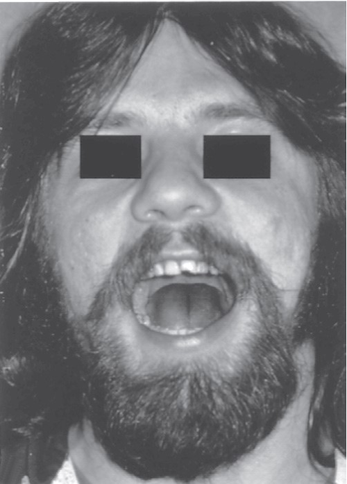 FIGURE 16-38, cont’d F, Postoperative radiograph showing reduction. G, Immediately postoperatively, patient has regained mobility of the mandible. H, Metal and gauze eye patches can be used to protect the reduced arch for several days (I).