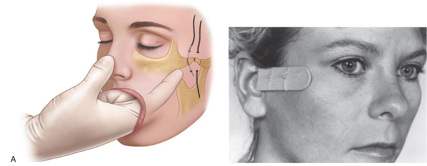 FIGURE 16-39 One method of stabilizing a reduced zygomatic arch fracture. A, A large curved needle or an awl is used to pass heavy suture or fine wires around the zygomatic arch. B, The wires are then secured to a stable object, such as a tongue blade and aluminum finger splints, until healing has occurred.