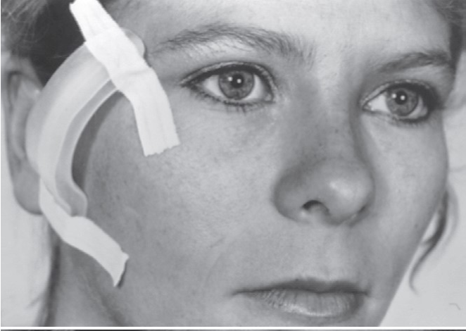 FIGURE 16-41 Patient 7 weeks after treatment of a right ZMC fracture through the transconjunctival approach with lateral canthotomy. Note 1 mm of scleral show.