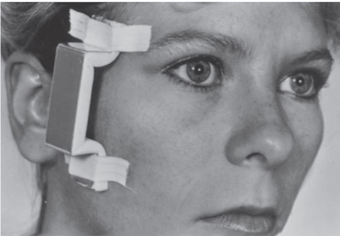 FIGURE 16-40 Methods of protecting a reduced zygomatic arch fracture. This can be easily accomplished by using an oral airway (A), aluminum finger splint material (B), or other suitable object that can be taped over the area for several days.