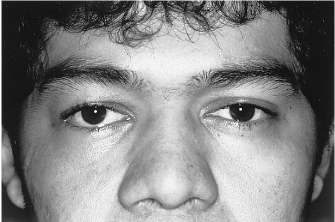 FIGURE 16-41 Patient 7 weeks after treatment of a right ZMC fracture through the transconjunctival approach with lateral canthotomy. Note 1 mm of scleral show.