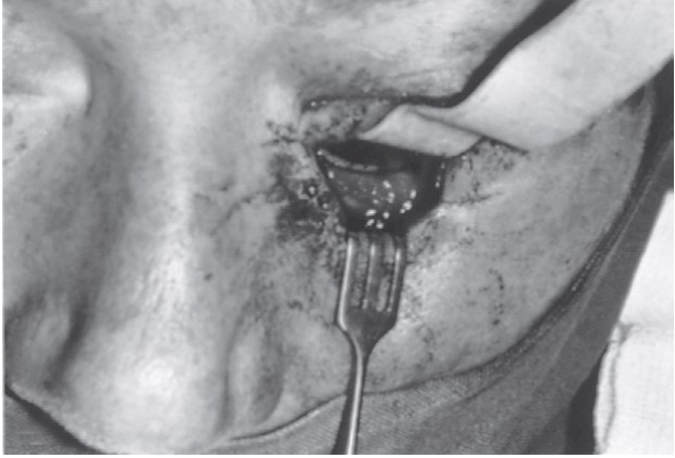 FIGURE 16-44 Patient who had a silicone implant used to reconstruct his orbital floor 13 months previously. A, For the past several months, he had intermittent swelling and drainage from this sinus tract. B, At surgery, the implant was found to be surrounded by chronic inflammatory tissue and was removed. The sinus tract was excised to gain access to the orbital floor. He had no further problems following implant removal.