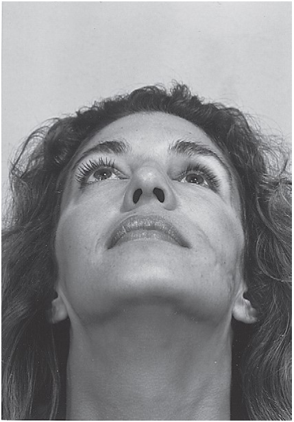 FIGURE 16-45 A, Clinical appearance 9 months after surgical correction of a left ZMC fracture (and facial lacerations). Note 3 to 4 mm of enophthalmos. B, Coronal CT scan showing large, untreated orbital floor and medial wall fractures. C, Intraoperative photograph of the left medial orbital wall exposed using the coronal approach. A porous polyethylene sheet was used to cover the entire medial orbital wall defect. Note that the sheet was stabilized with a bone screw. The sheet extended down to the orbital floor, covering that defect. D, Intraoperative photograph of the floor of the left orbital floor showing a sheet of polyethylene from the medial wall, covering a defect in the orbital floo