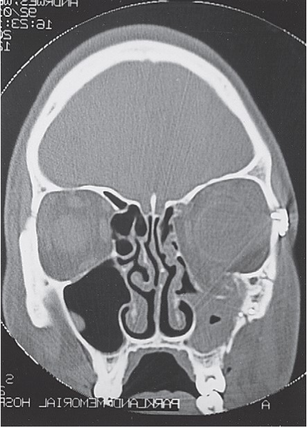 FIGURE 16-45 A, Clinical appearance 9 months after surgical correction of a left ZMC fracture (and facial lacerations). Note 3 to 4 mm of enophthalmos. B, Coronal CT scan showing large, untreated orbital floor and medial wall fractures. C, Intraoperative photograph of the left medial orbital wall exposed using the coronal approach. A porous polyethylene sheet was used to cover the entire medial orbital wall defect. Note that the sheet was stabilized with a bone screw. The sheet extended down to the orbital floor, covering that defect. D, Intraoperative photograph of the floor of the left orbital floor showing a sheet of polyethylene from the medial wall, covering a defect in the orbital floo