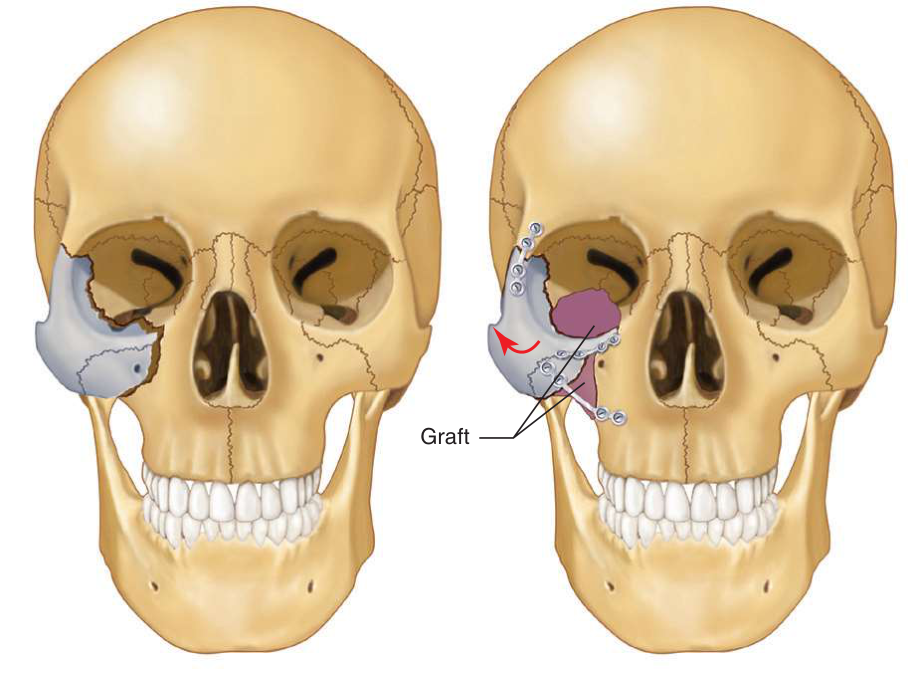 FIGURE 16-46 Osteotomy to reposition the malaligned ZMC. In most cases, the old fracture site is visible and may serve as the osteotomy site. Left, Note the medial rotation of the right zygomaticomaxillary buttress into the maxillary sinus. Right, Following repositioning and stabilization, it is usually necessary to bone-graft the area of the zygomatic buttress of the maxilla to rotate the body of the zygoma outward and upward. Internal orbital reconstruction may also be necessary.